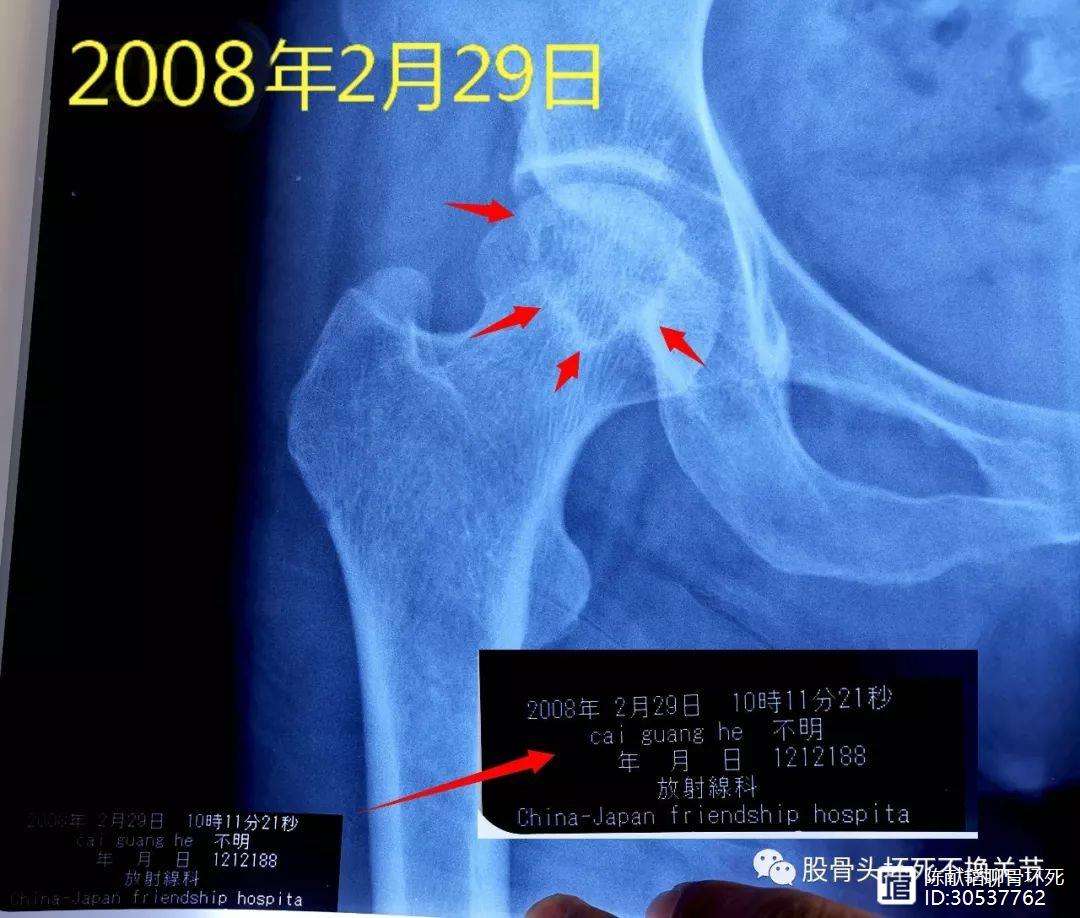 白山人工骨头医保报销多少(人工骨头医保报销多少比例)
