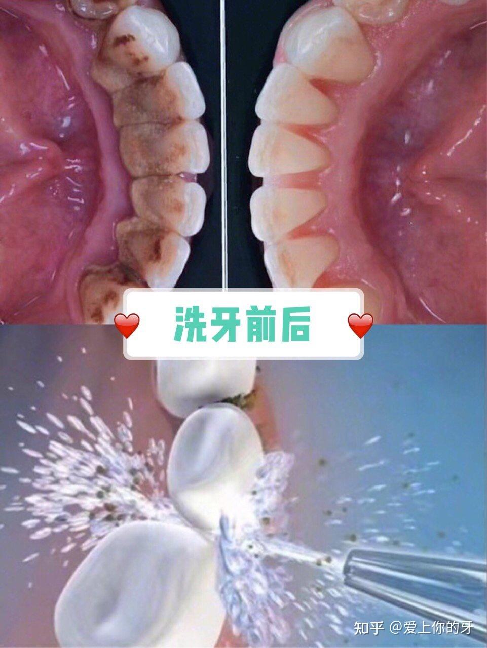 白山洗牙可以用医保吗(洗牙可以用医保吗,报销比例多少)